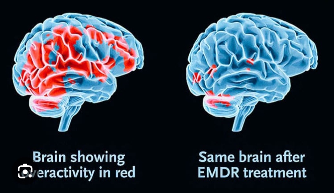 EMDR